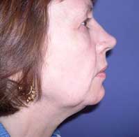  Genioplasty