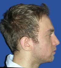 chinplasty