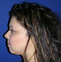 chinplasty