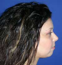 chinplasty