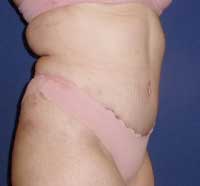 Tummy tuck
