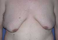 γυναικομαστία μετά από απώλεια βάρους