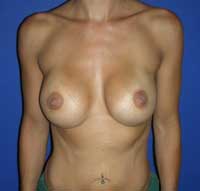 breast augmentation