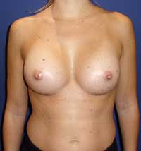 Αυξητική στήθους