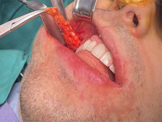 Buccal Fat Removal