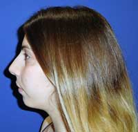 chin augmentation