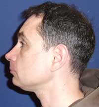 Chin surgery