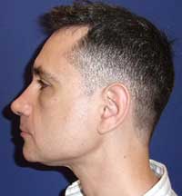 Genioplasty