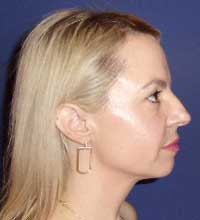 chin surgery