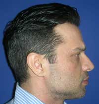 chin plasty