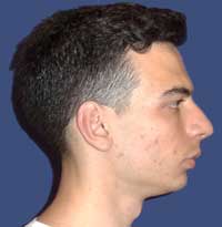 chin surgery