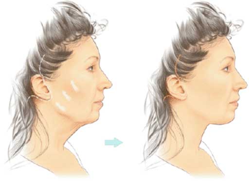 Face lift