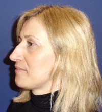 Rhinoplasty, Septoplasty