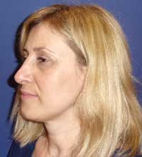Rhinoplasty, Septoplasty