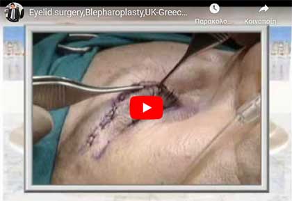 Eyelid- Blefaroplasty